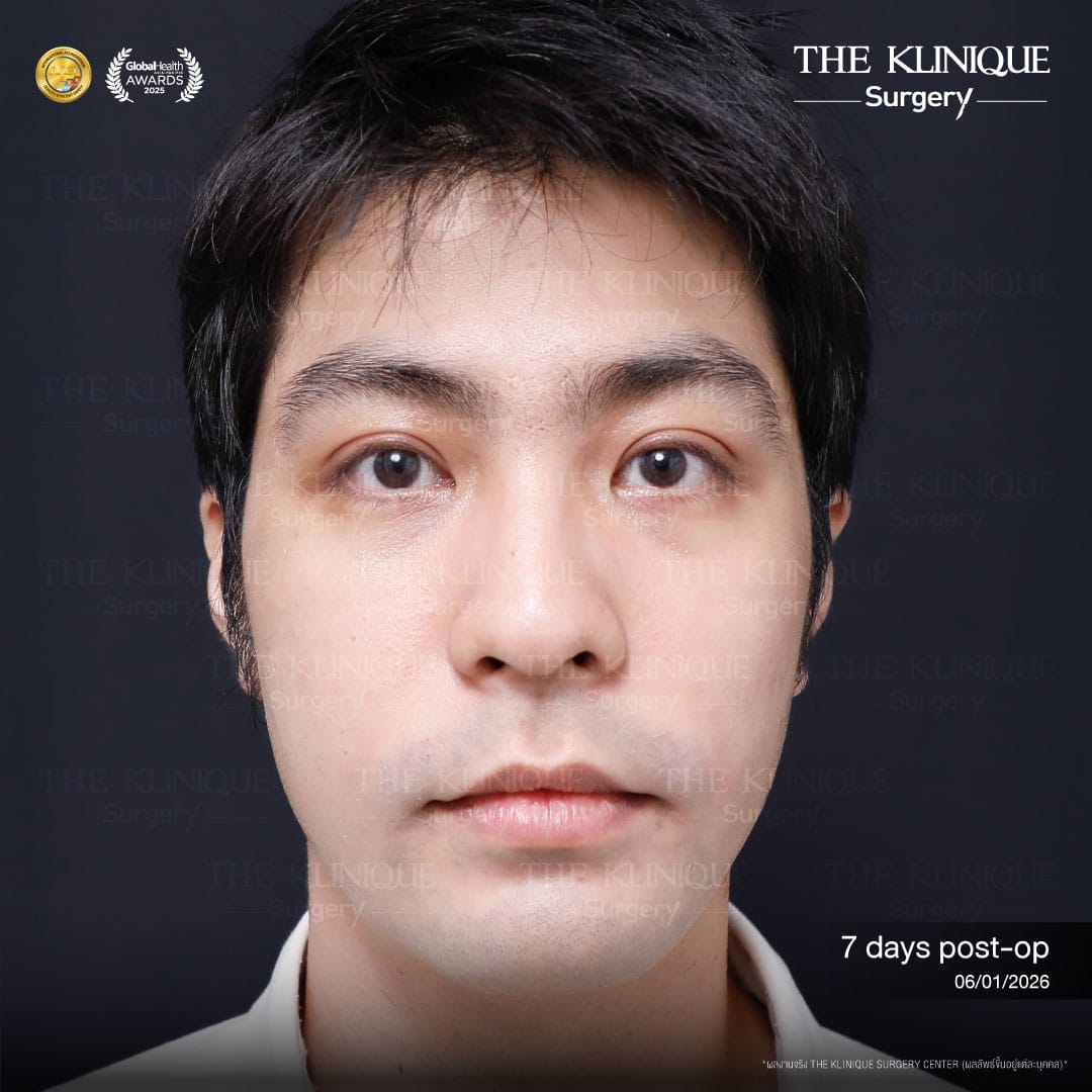 ศัลยกรรมตา, ศัลยกรรมตาสองชั้น, ศัลยกรรมตาสองชั้น ราคา, ศัลยกรรมตาที่ไหนดี, ศัลยกรรมตามีกี่แบบ, ตาสองชั้น, ตาสองชั้นหลบใน, คลินิกทำตา, ตาสองชั้นที่ไหนดี, ตาสองชั้นแบบกรีดสั้น กรีดยาว, กล้ามเนื้อตาอ่อนแรง, แก้ตา, แก้ตาสองชั้น, แก้หนังตาตก, แก้ชั้นตาใหญ่, แก้ตาไม่เท่ากัน, หนังตาตก, แก้หนังตาตก,Ophthalmologis,จักษุศัลยแพทย์,คลินิกทำตาสองชั้น ใจกลางสยามสแคว์ , แก้ตาอ่อนแรง ใจกลางสยาม,ตาง่วง, ตาปรือ, ทำตาสองชั้นที่ไหนดี, แพทย์ Oculoplastic, มัดกล้ามเนื้อตา, รีวิวแก้กล้ามเนื้อตาอ่อนแรง, แก้ไขกล้ามเนื้อตาอ่อนแรง