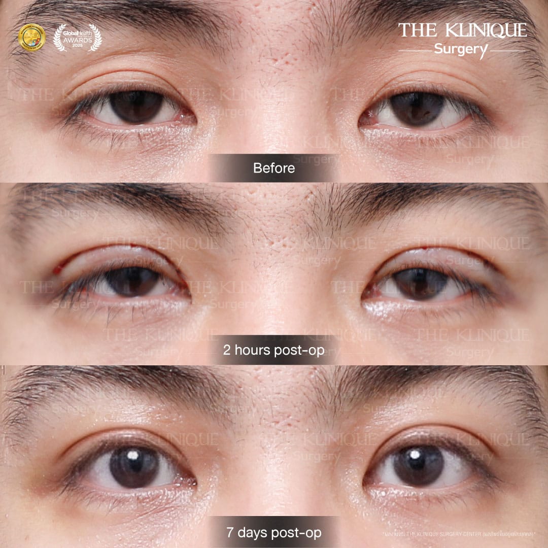 ศัลยกรรมตา, ศัลยกรรมตาสองชั้น, ศัลยกรรมตาสองชั้น ราคา, ศัลยกรรมตาที่ไหนดี, ศัลยกรรมตามีกี่แบบ, ตาสองชั้น, ตาสองชั้นหลบใน, คลินิกทำตา, ตาสองชั้นที่ไหนดี, ตาสองชั้นแบบกรีดสั้น กรีดยาว, กล้ามเนื้อตาอ่อนแรง, แก้ตา, แก้ตาสองชั้น, แก้หนังตาตก, แก้ชั้นตาใหญ่, แก้ตาไม่เท่ากัน, หนังตาตก, แก้หนังตาตก,Ophthalmologis,จักษุศัลยแพทย์,คลินิกทำตาสองชั้น ใจกลางสยามสแคว์ , แก้ตาอ่อนแรง ใจกลางสยาม,ตาง่วง, ตาปรือ, ทำตาสองชั้นที่ไหนดี, แพทย์ Oculoplastic, มัดกล้ามเนื้อตา, รีวิวแก้กล้ามเนื้อตาอ่อนแรง, แก้ไขกล้ามเนื้อตาอ่อนแรง