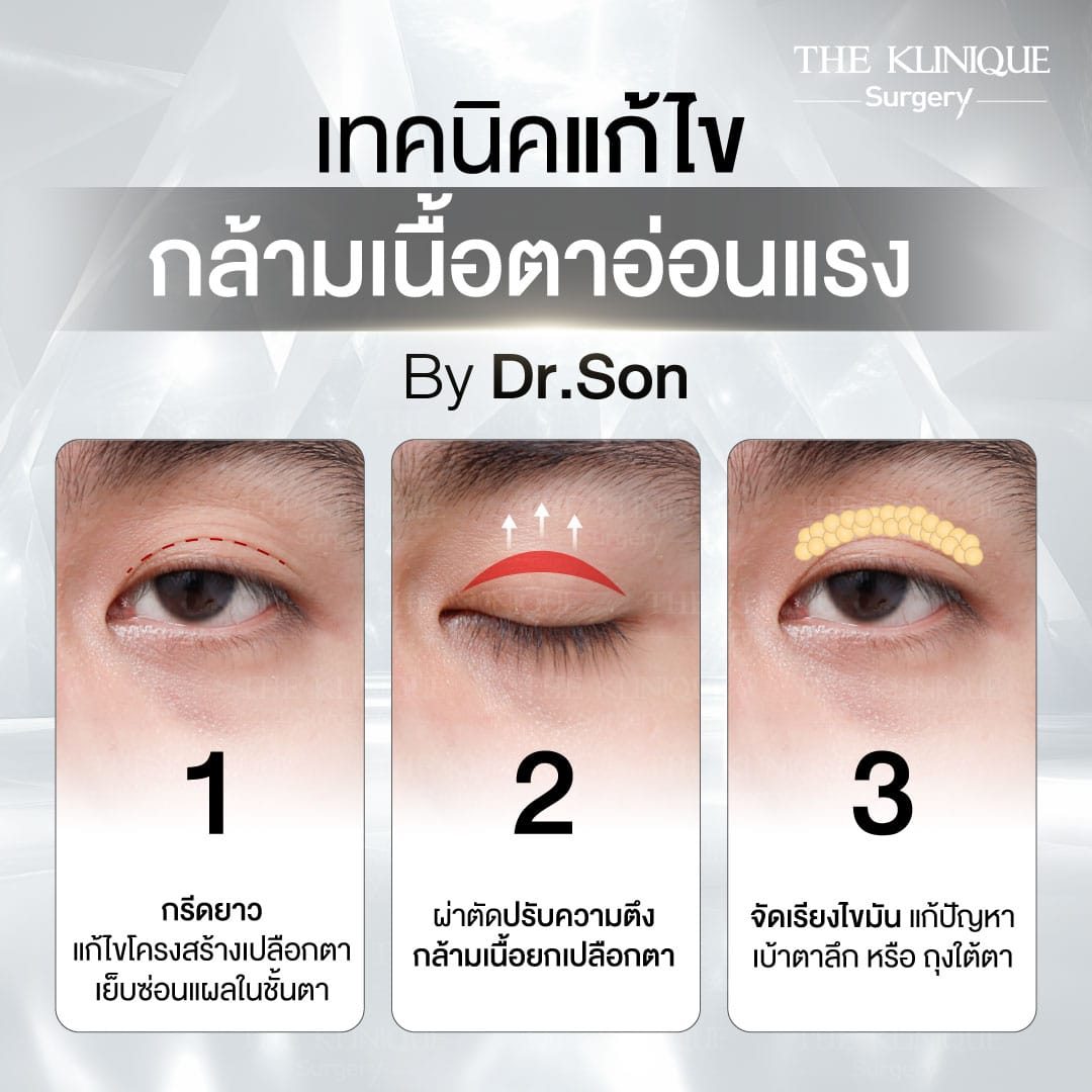 ศัลยกรรมตา, ศัลยกรรมตาสองชั้น, ศัลยกรรมตาสองชั้น ราคา, ศัลยกรรมตาที่ไหนดี, ศัลยกรรมตามีกี่แบบ, ตาสองชั้น, ตาสองชั้นหลบใน, คลินิกทำตา, ตาสองชั้นที่ไหนดี, ตาสองชั้นแบบกรีดสั้น กรีดยาว, กล้ามเนื้อตาอ่อนแรง, แก้ตา, แก้ตาสองชั้น, แก้หนังตาตก, แก้ชั้นตาใหญ่, แก้ตาไม่เท่ากัน, หนังตาตก, แก้หนังตาตก,Ophthalmologis,จักษุศัลยแพทย์,คลินิกทำตาสองชั้น ใจกลางสยามสแคว์ , แก้ตาอ่อนแรง ใจกลางสยาม,ตาง่วง, ตาปรือ, ทำตาสองชั้นที่ไหนดี, แพทย์ Oculoplastic, มัดกล้ามเนื้อตา, รีวิวแก้กล้ามเนื้อตาอ่อนแรง, แก้ไขกล้ามเนื้อตาอ่อนแรง