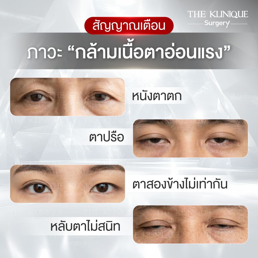 ศัลยกรรมตา, ศัลยกรรมตาสองชั้น, ศัลยกรรมตาสองชั้น ราคา, ศัลยกรรมตาที่ไหนดี, ศัลยกรรมตามีกี่แบบ, ตาสองชั้น, ตาสองชั้นหลบใน, คลินิกทำตา, ตาสองชั้นที่ไหนดี, ตาสองชั้นแบบกรีดสั้น กรีดยาว, กล้ามเนื้อตาอ่อนแรง, แก้ตา, แก้ตาสองชั้น, แก้หนังตาตก, แก้ชั้นตาใหญ่, แก้ตาไม่เท่ากัน, หนังตาตก, แก้หนังตาตก,Ophthalmologis,จักษุศัลยแพทย์,คลินิกทำตาสองชั้น ใจกลางสยามสแคว์ , แก้ตาอ่อนแรง ใจกลางสยาม,ตาง่วง, ตาปรือ, ทำตาสองชั้นที่ไหนดี, แพทย์ Oculoplastic, มัดกล้ามเนื้อตา, รีวิวแก้กล้ามเนื้อตาอ่อนแรง, แก้ไขกล้ามเนื้อตาอ่อนแรง