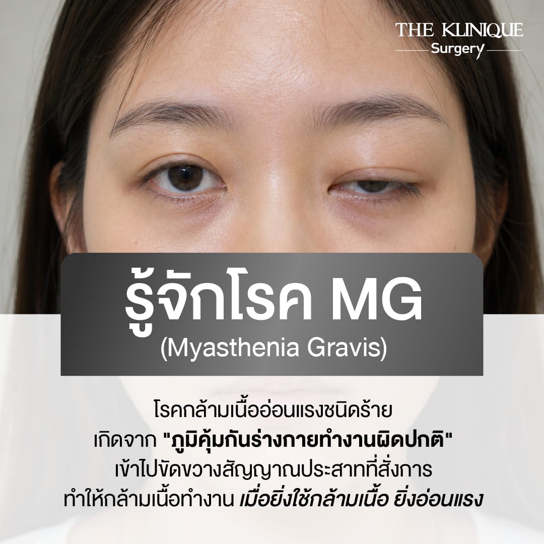 ศัลยกรรมตา, ศัลยกรรมตาสองชั้น, ศัลยกรรมตาสองชั้น ราคา, ศัลยกรรมตาที่ไหนดี, ศัลยกรรมตามีกี่แบบ, ตาสองชั้น, ตาสองชั้นหลบใน, คลินิกทำตา, ตาสองชั้นที่ไหนดี, ตาสองชั้นแบบกรีดสั้น กรีดยาว, กล้ามเนื้อตาอ่อนแรง, แก้ตา, แก้ตาสองชั้น, แก้หนังตาตก, แก้ชั้นตาใหญ่, แก้ตาไม่เท่ากัน, หนังตาตก, แก้หนังตาตก,Ophthalmologis,จักษุศัลยแพทย์,คลินิกทำตาสองชั้น ใจกลางสยามสแคว์ , แก้ตาอ่อนแรง ใจกลางสยาม,ตาง่วง, ตาปรือ, ทำตาสองชั้นที่ไหนดี, แพทย์ Oculoplastic, มัดกล้ามเนื้อตา, รีวิวแก้กล้ามเนื้อตาอ่อนแรง, แก้ไขกล้ามเนื้อตาอ่อนแรง
