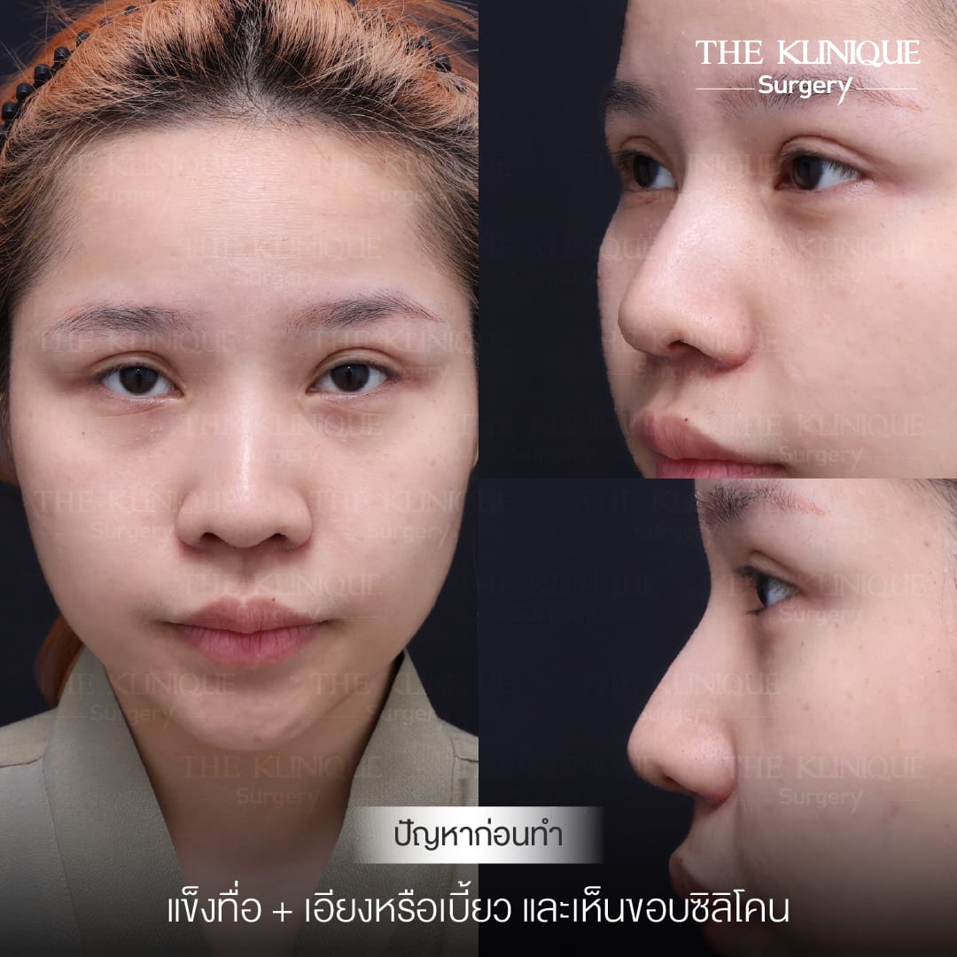 เคสแก้จมูกพังเป็นงานปังด้วยเทคนิค เสริมจมูก Semi Open โดยคุณหมอโซอา The Klinique Surgery
