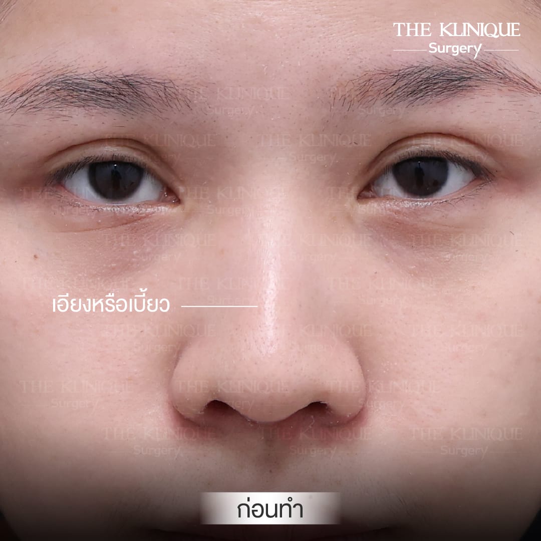 เคสแก้จมูกพังเป็นงานปังด้วยเทคนิค เสริมจมูก Semi Open โดยคุณหมอโซอา The Klinique Surgery