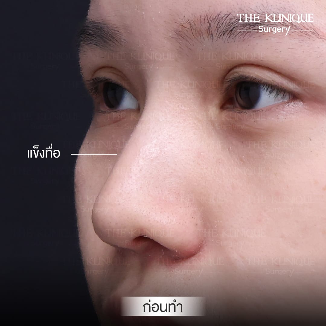 เคสแก้จมูกพังเป็นงานปังด้วยเทคนิค เสริมจมูก Semi Open โดยคุณหมอโซอา The Klinique Surgery