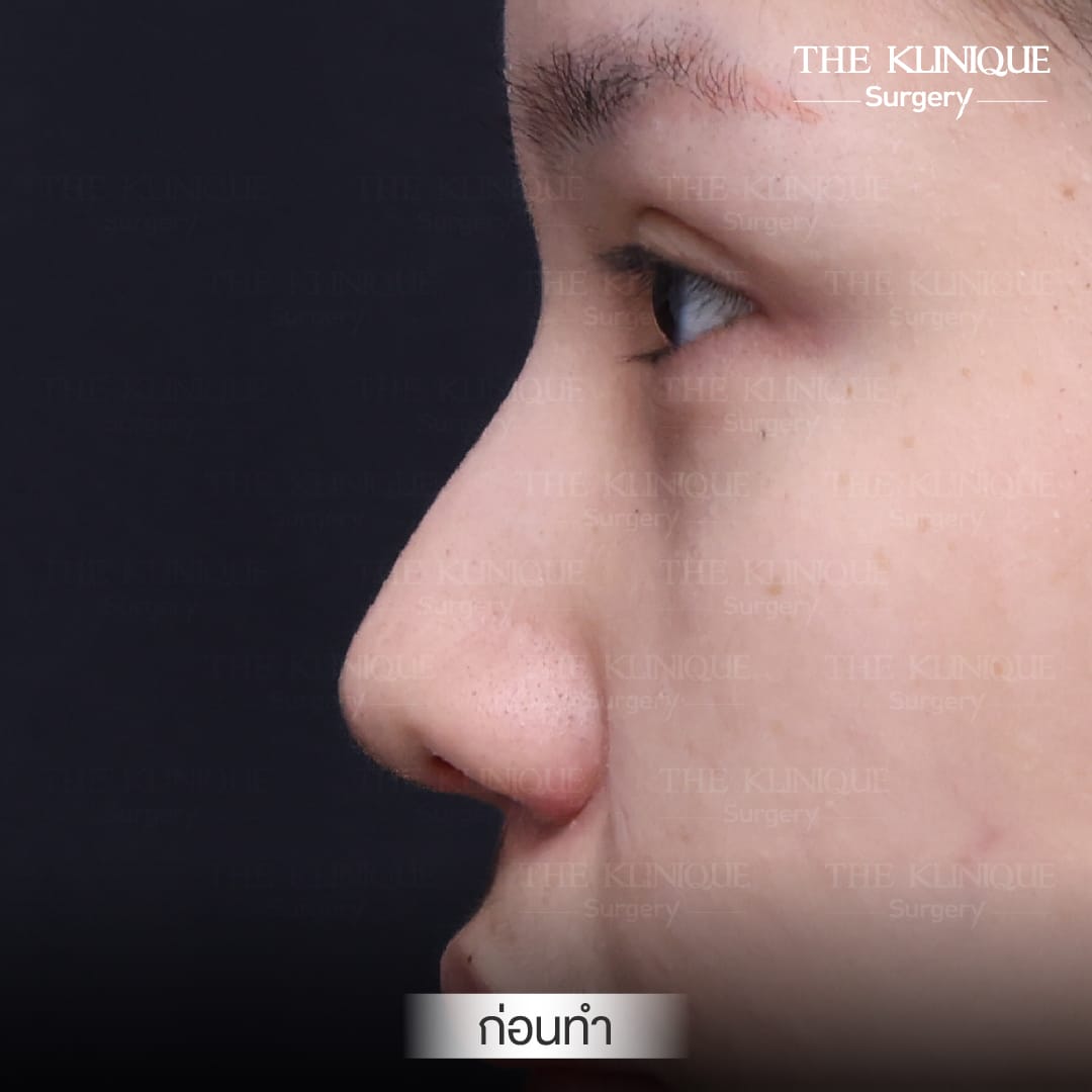 เคสแก้จมูกพังเป็นงานปังด้วยเทคนิค เสริมจมูก Semi Open โดยคุณหมอโซอา The Klinique Surgery