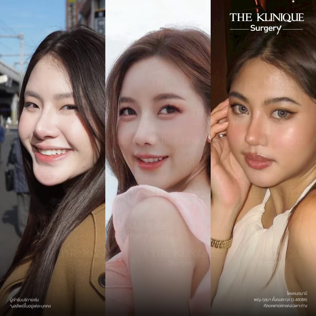 รีวิว เสริมจมูก semi open สไตล์ พส. จีน