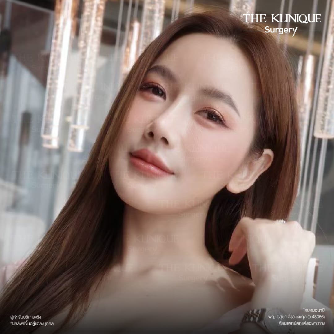 รีวิว เสริมจมูก semi open สไตล์ พส. จีน