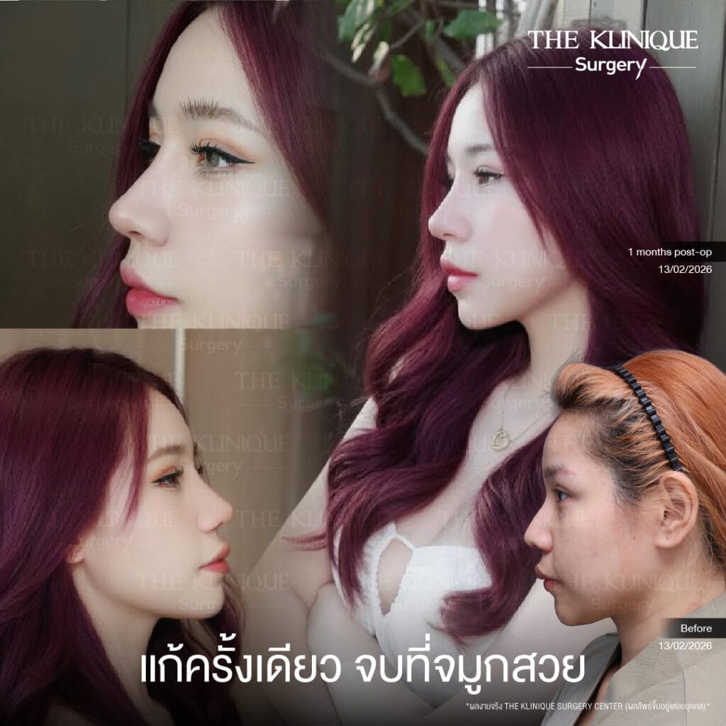 เคสแก้จมูกพังเป็นงานปังด้วยเทคนิค เสริมจมูก Semi Open โดยคุณหมอโซอา The Klinique Surgery