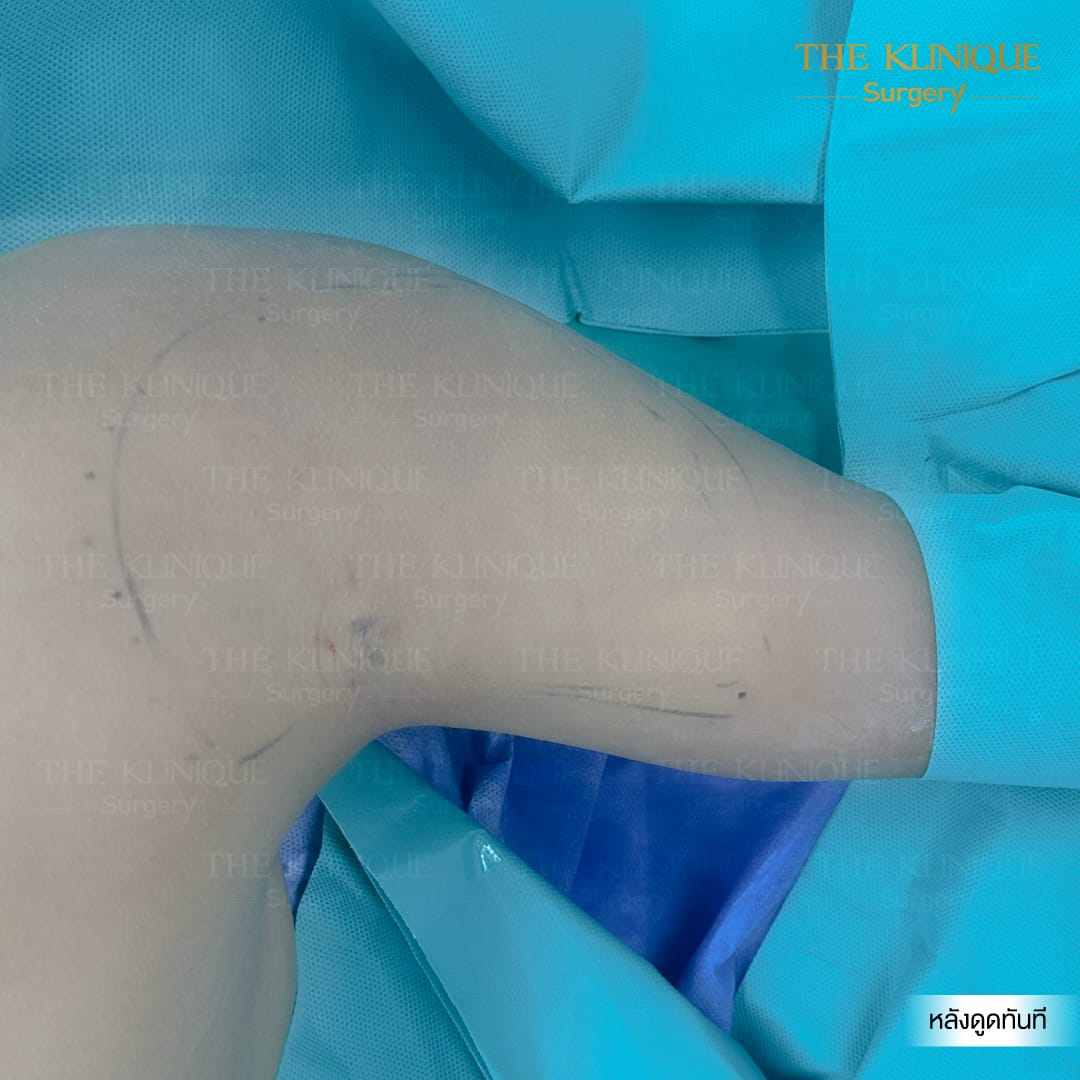 Liposuction, Sculpting,Xshape,Lipo, ศัลยกรรมดูดไขมัน, ดูดไขมัน,คลินิกดูดไขมัน,ดูดไขมันเฉพาะส่วน,ดูดไขมันเหนียง,ดูดไขมันหน้าท้อง,ดูดไขมันรีวิว, รีวิวดูดไขมัน, รีวิวดูดไขมันหน้าท้อง,ดูดไขมันต้นแขน, ดูดไขมันต้นขา,ดูดไขมันน่อง, ลดความอ้วน, ดูดไขมันที่ไหนดี, ดูดไขมันราคา, ดูดไขมันทั้งตัว, รีวิว ดูดไขมันต้นขา, ดูดไขมันขา