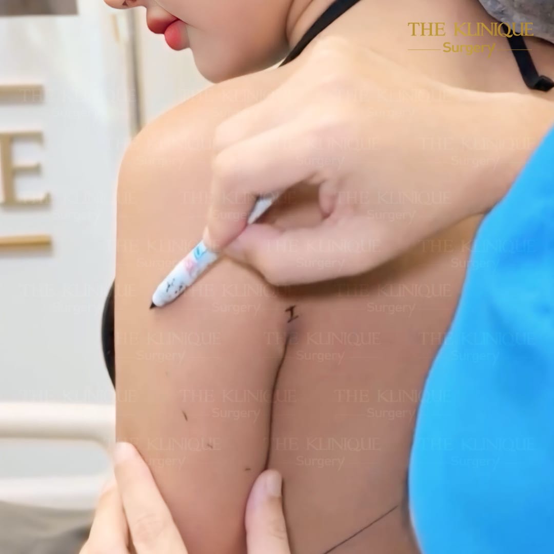 Liposuction, Sculpting,Xshape,Lipo, ศัลยกรรมดูดไขมัน, ดูดไขมัน,คลินิกดูดไขมัน,ดูดไขมันเฉพาะส่วน,ดูดไขมันเหนียง,ดูดไขมันหน้าท้อง,ดูดไขมันรีวิว, รีวิวดูดไขมัน, รีวิวดูดไขมันหน้าท้อง,ดูดไขมันต้นแขน, ดูดไขมันต้นขา,ดูดไขมันน่อง, ลดความอ้วน, ดูดไขมันที่ไหนดี, ดูดไขมันราคา, ดูดไขมันทั้งตัว, รีวิว ดูดไขมันต้นขา, ดูดไขมันขา
