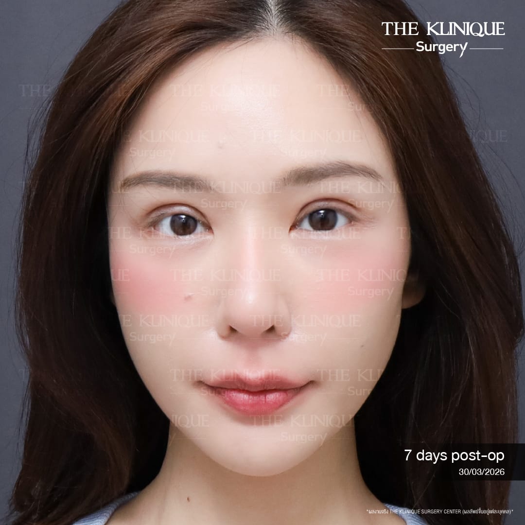 "Before and after revision double eyelid surgery by Dr. Son at THE KLINIQUE