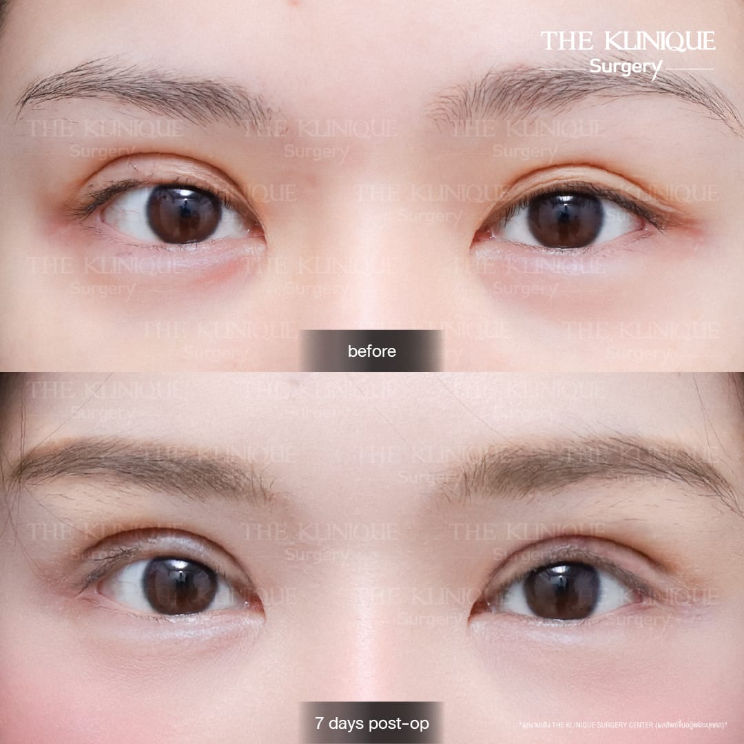 "Before and after revision double eyelid surgery by Dr. Son at THE KLINIQUE