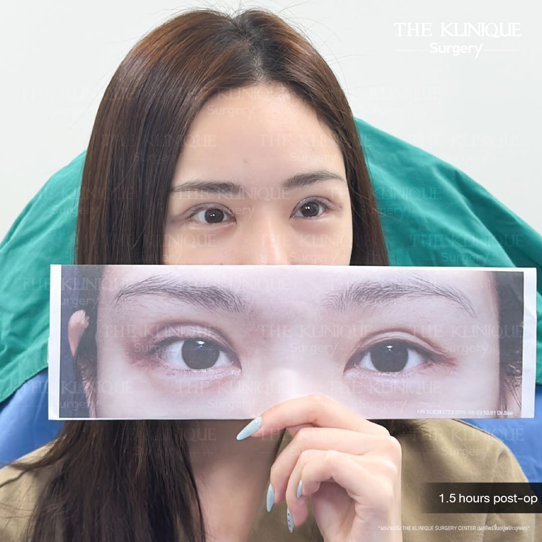 "Before and after revision double eyelid surgery by Dr. Son at THE KLINIQUE