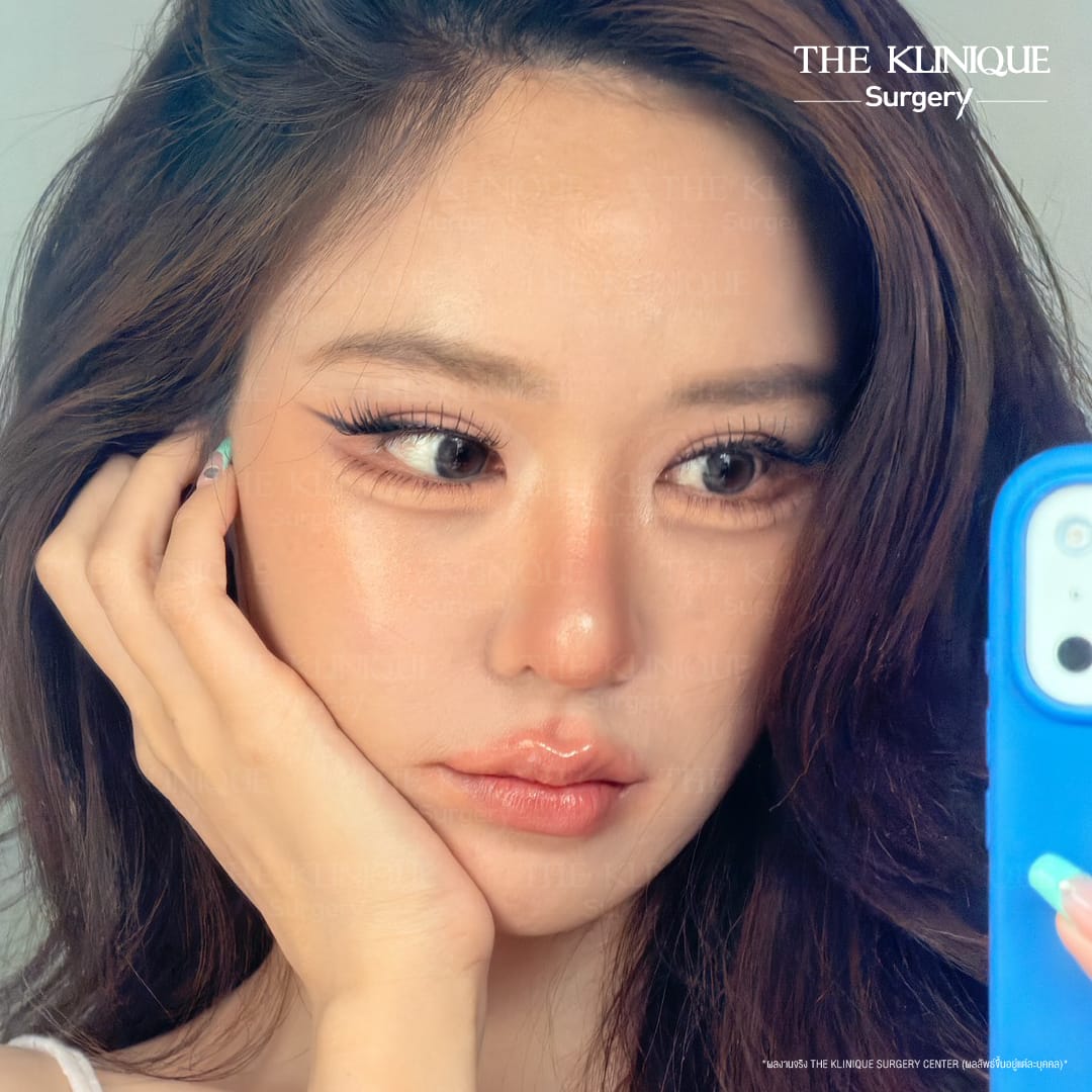 "Before and after revision double eyelid surgery by Dr. Son at THE KLINIQUE