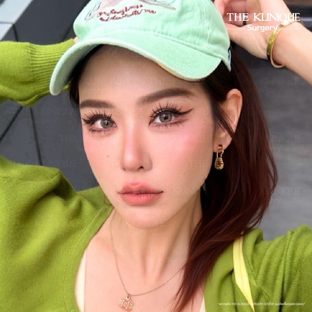 "Before and after revision double eyelid surgery by Dr. Son at THE KLINIQUE