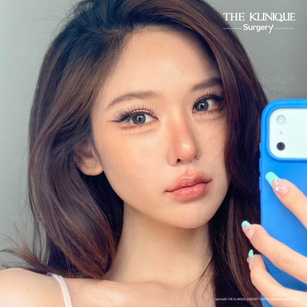"Before and after revision double eyelid surgery by Dr. Son at THE KLINIQUE