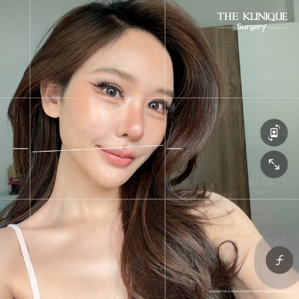 "Before and after revision double eyelid surgery by Dr. Son at THE KLINIQUE