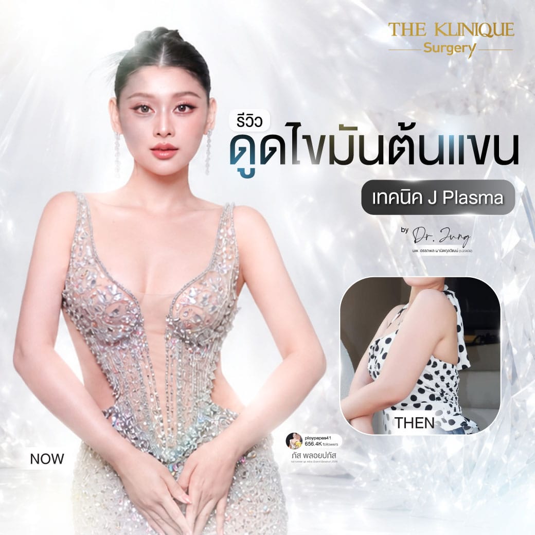 รีวิวดูดไขมันต้นแขน