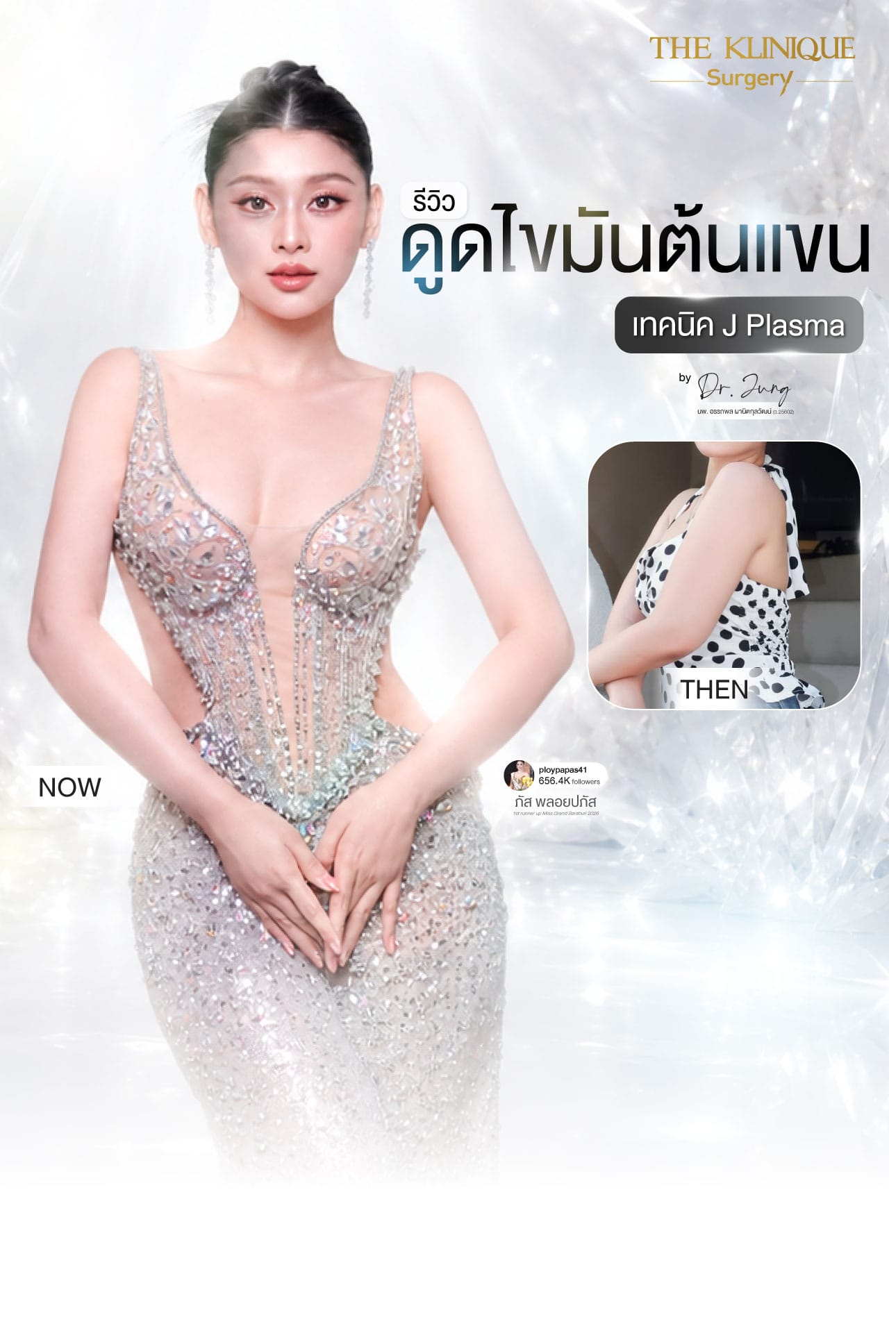 รีวิวดูดไขมันแขน
