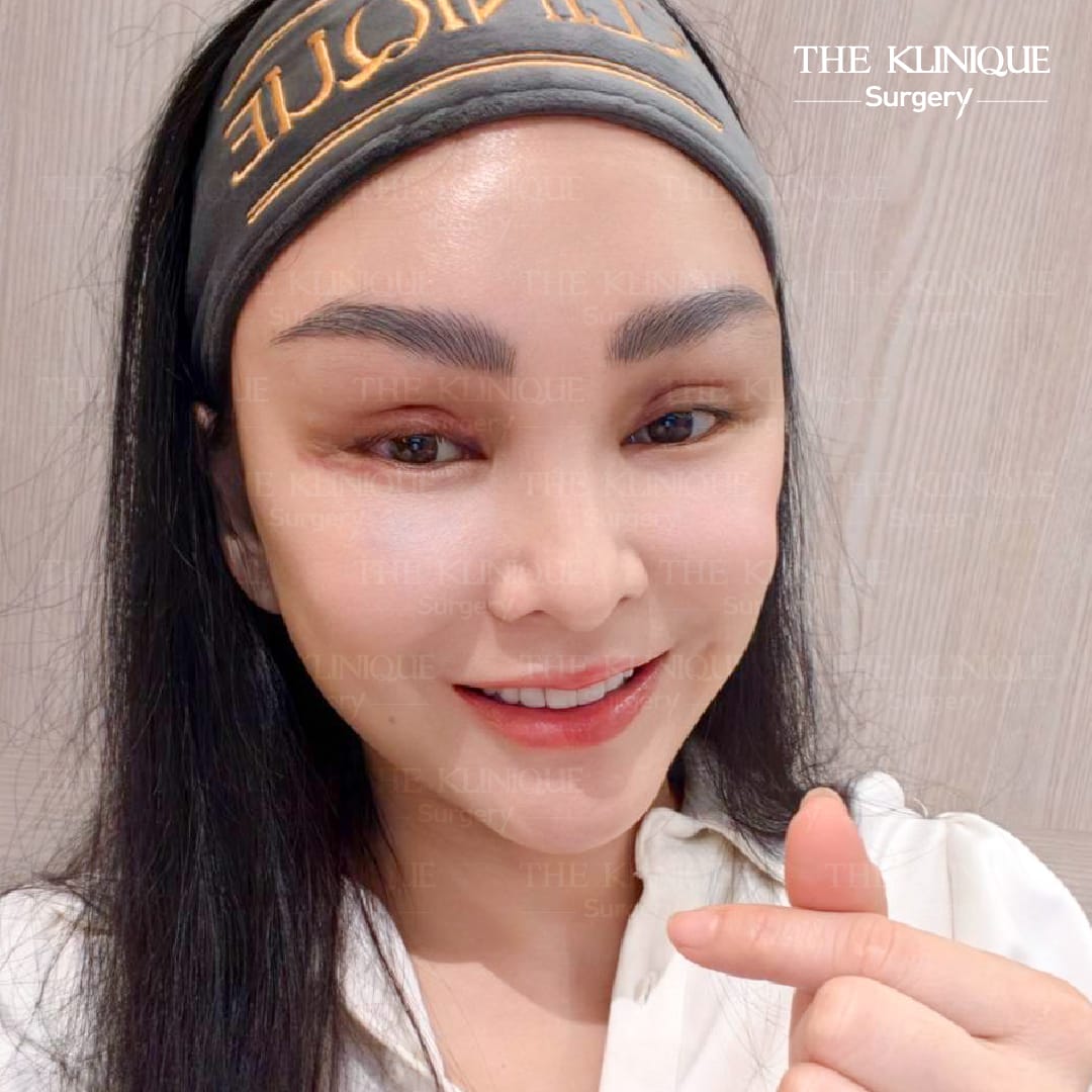 ดึงหน้า Facelift ย้อนวัยหน้าเด็กของคุณแคนดี้ รากแก่น