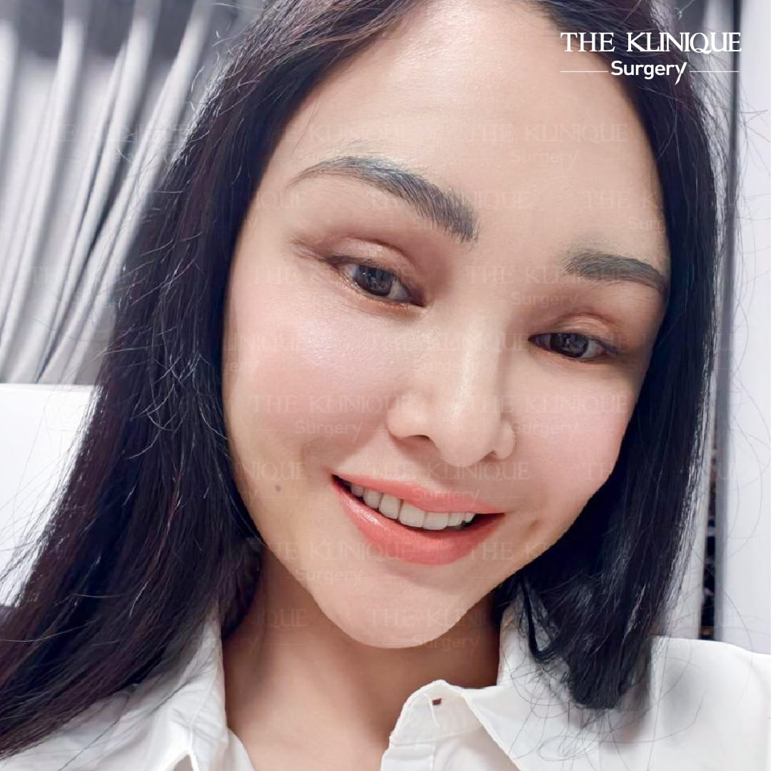 ดึงหน้า Facelift ย้อนวัยหน้าเด็กของคุณแคนดี้ รากแก่น