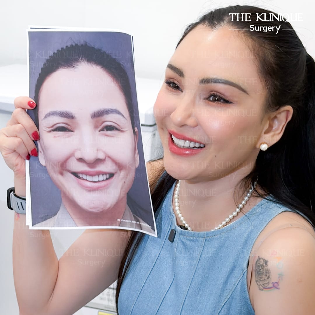 ดึงหน้า Facelift ย้อนวัยหน้าเด็กของคุณแคนดี้ รากแก่น