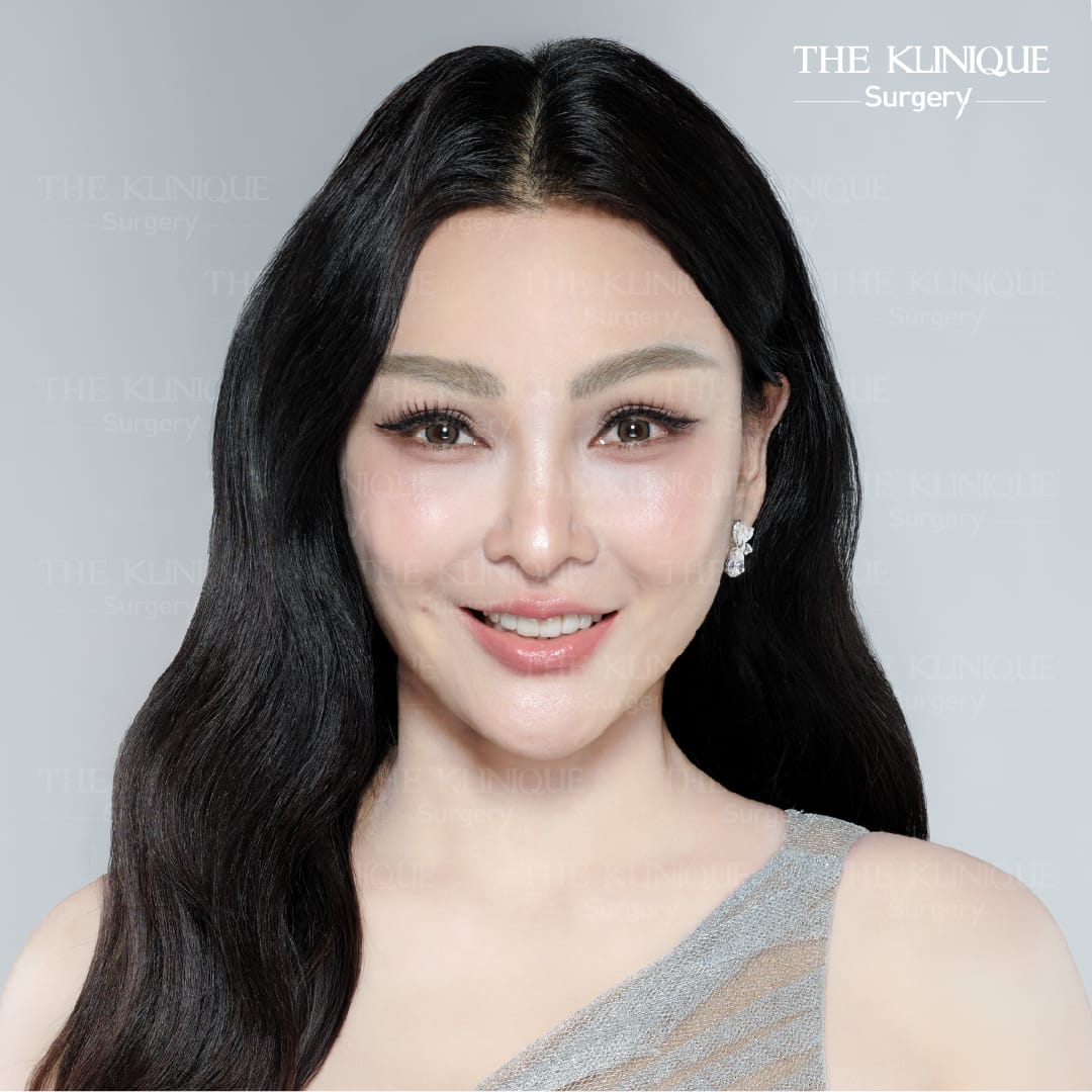 รีวิว ดึงหน้า Facelift