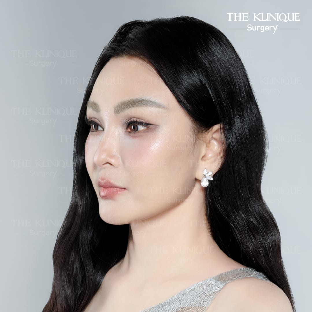 รีวิว ดึงหน้า Facelift