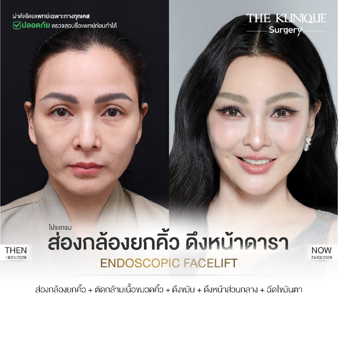 Before after Facelift