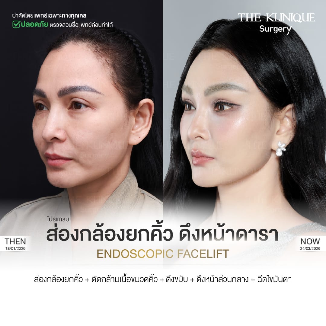 Before after Facelift