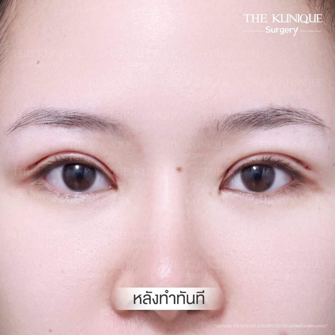 รีวิวแก้กล้ามเนื้อตาอ่อนแรง