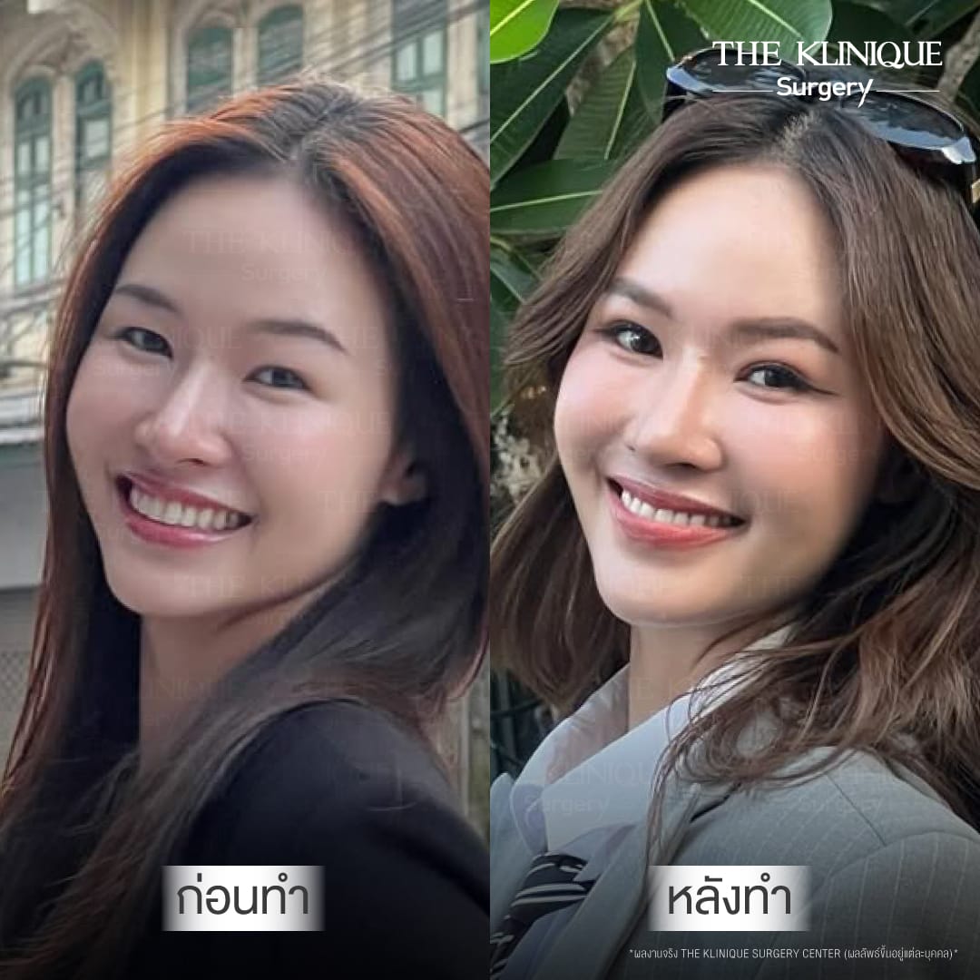 Before After รีวิว ตาสองชั้น Miss World Laos 2026