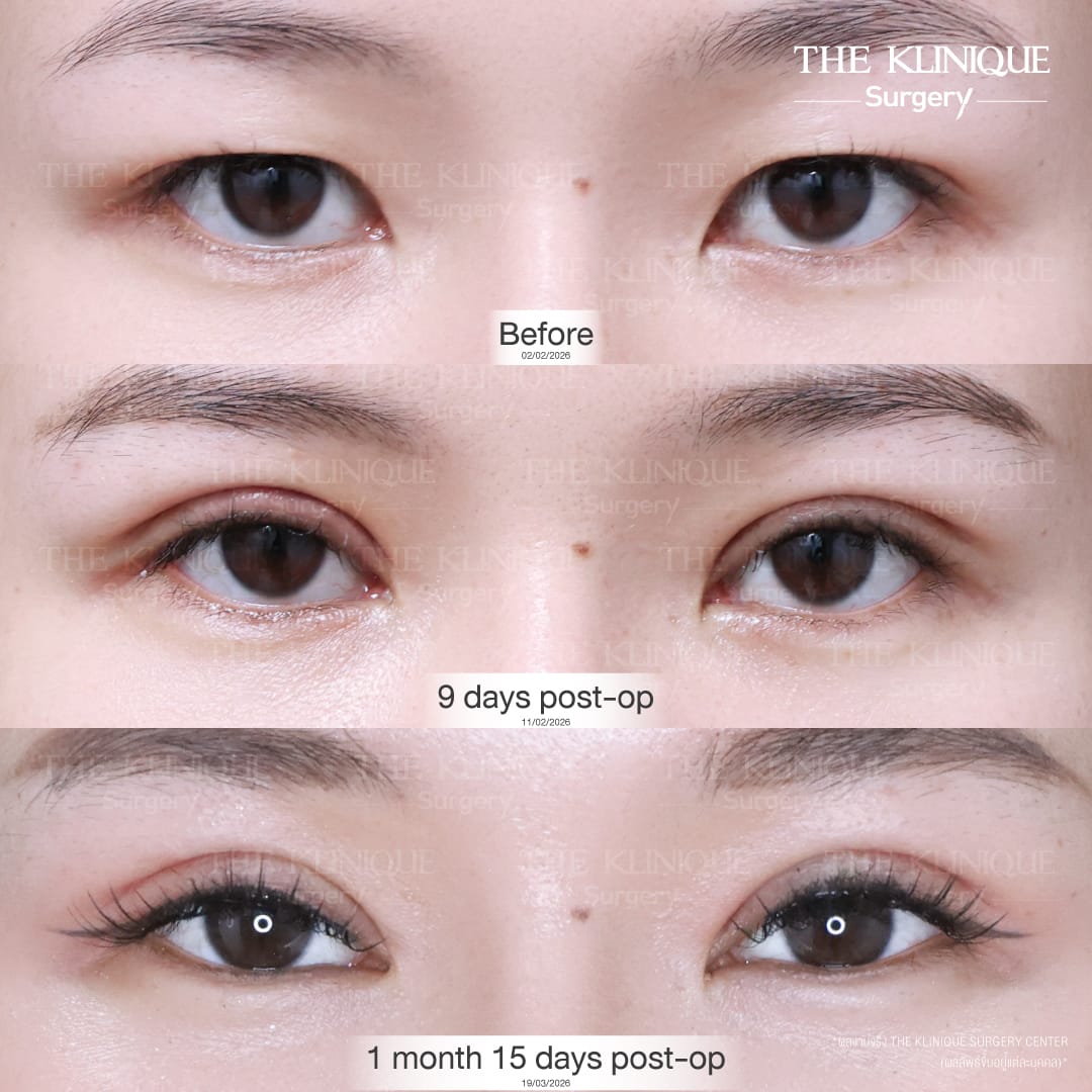 Before After รีวิว ตาสองชั้น Miss World Laos 2026
