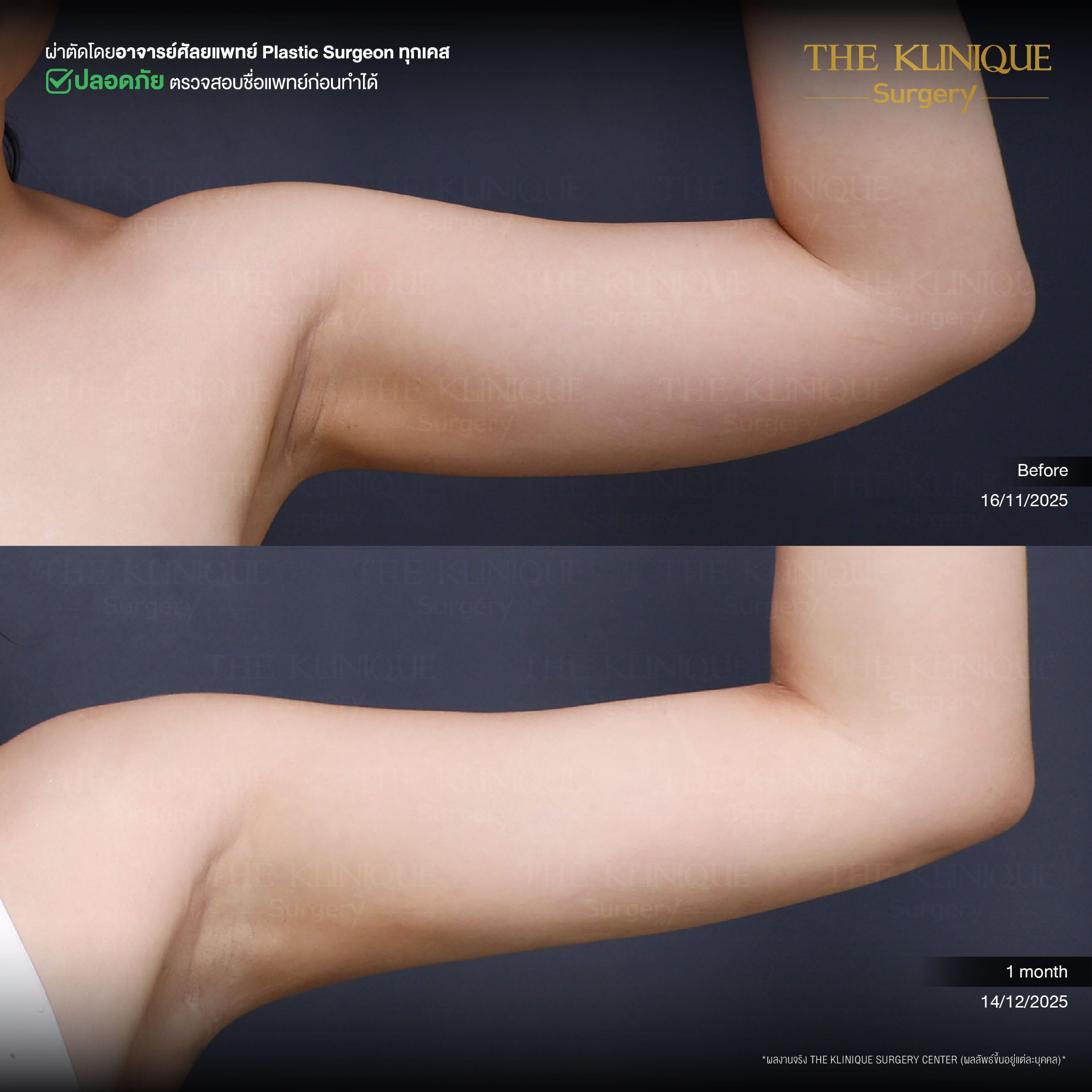 Before-After Lipo