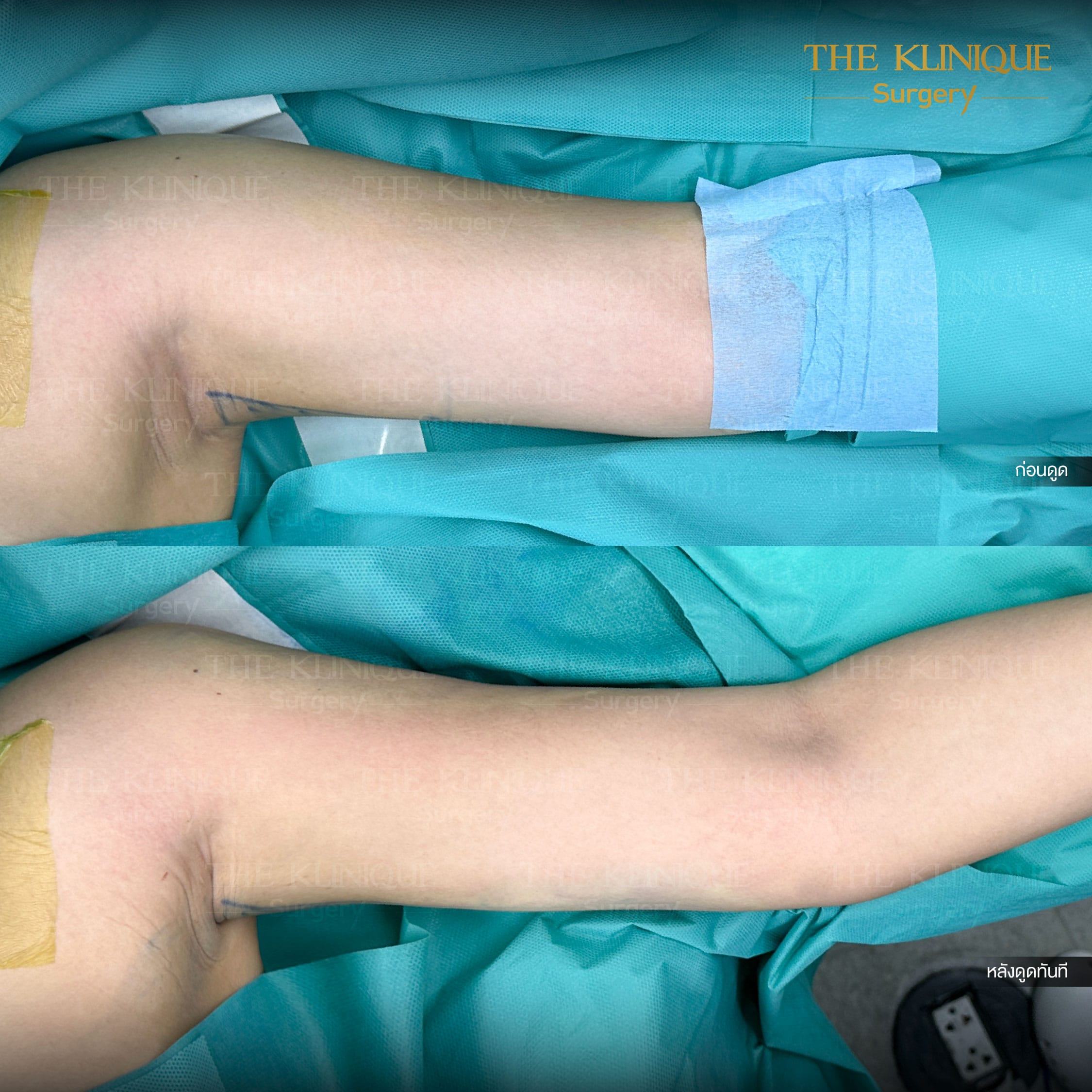 Before-After Lipo