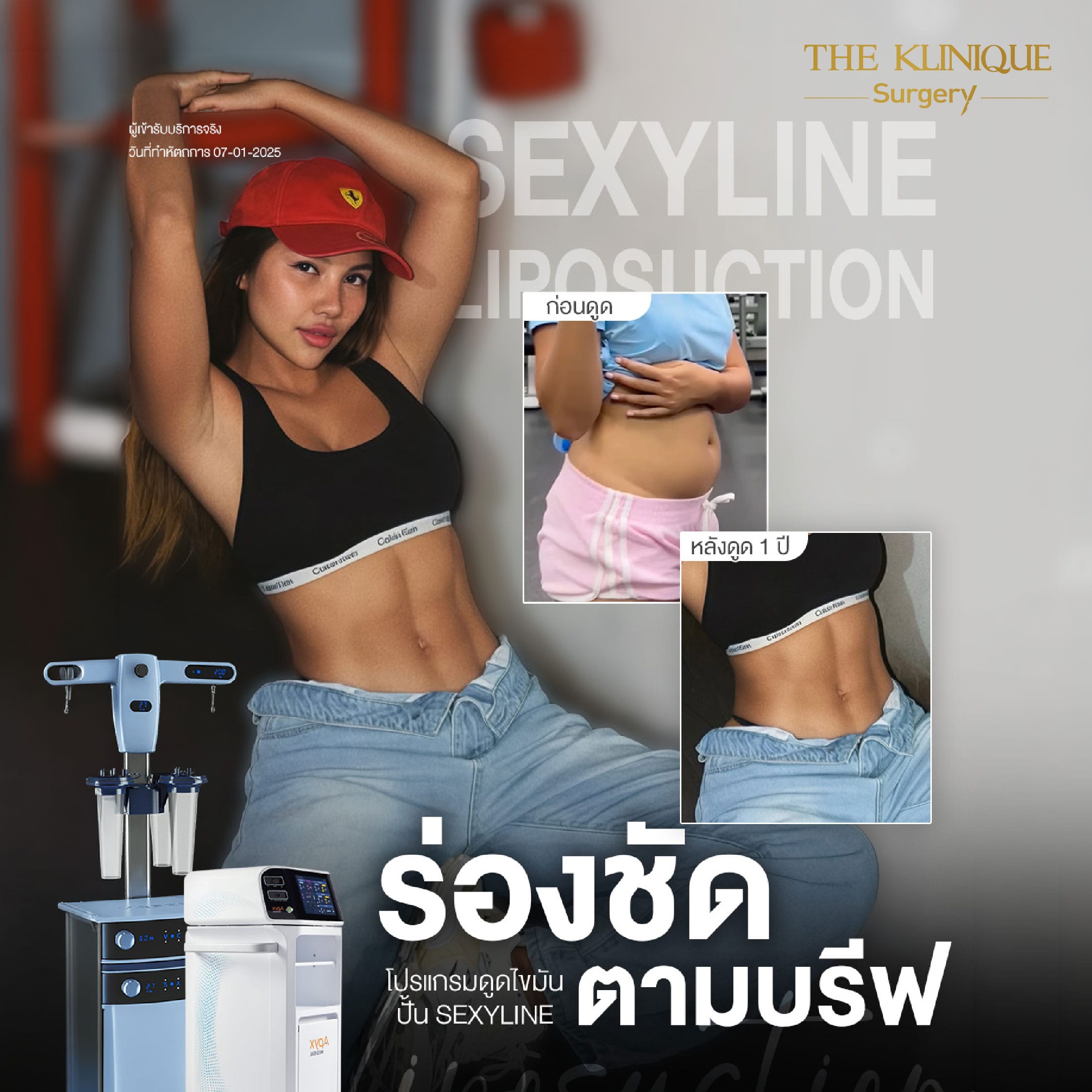 ดูดไขมันครบ1ปี