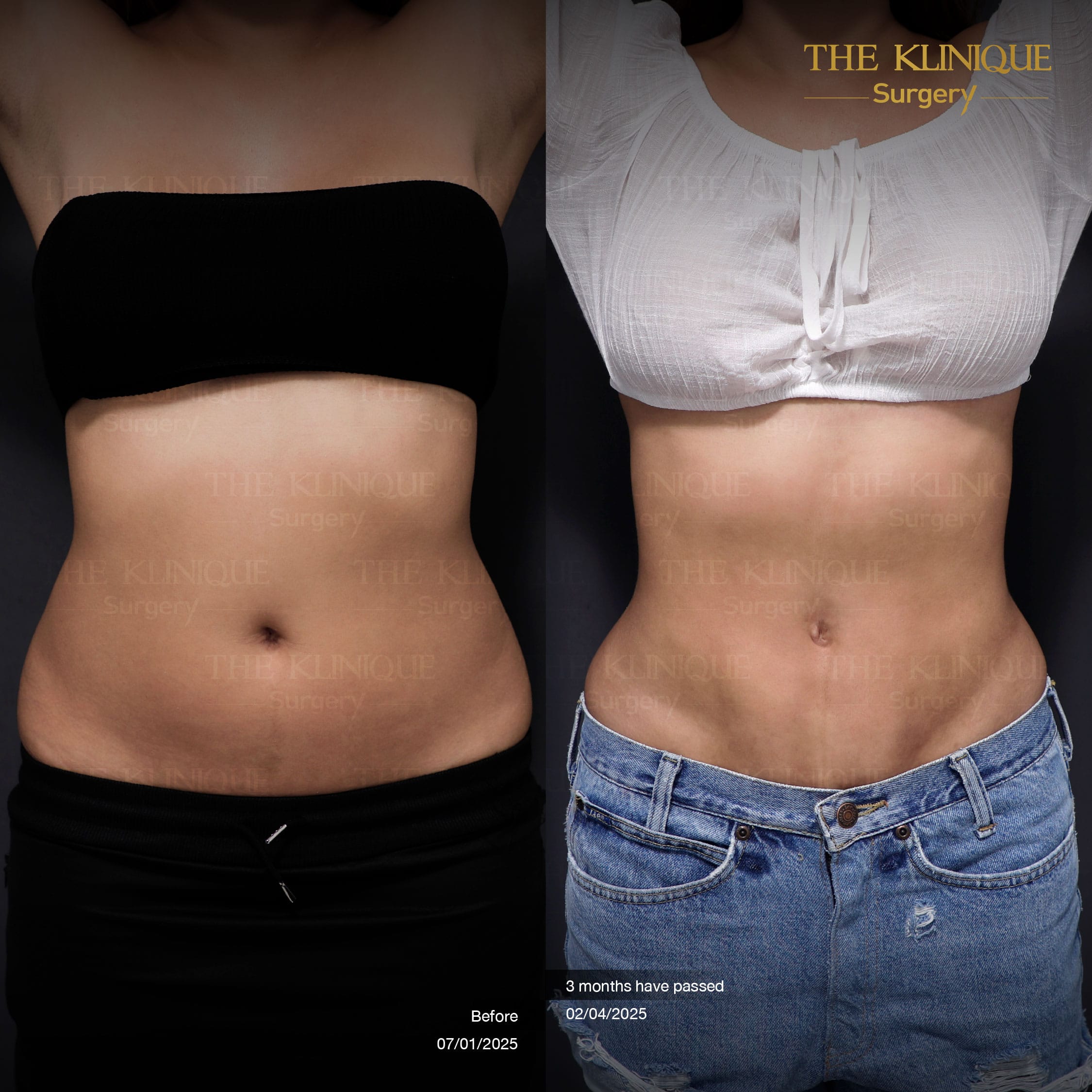 before-after-lipo