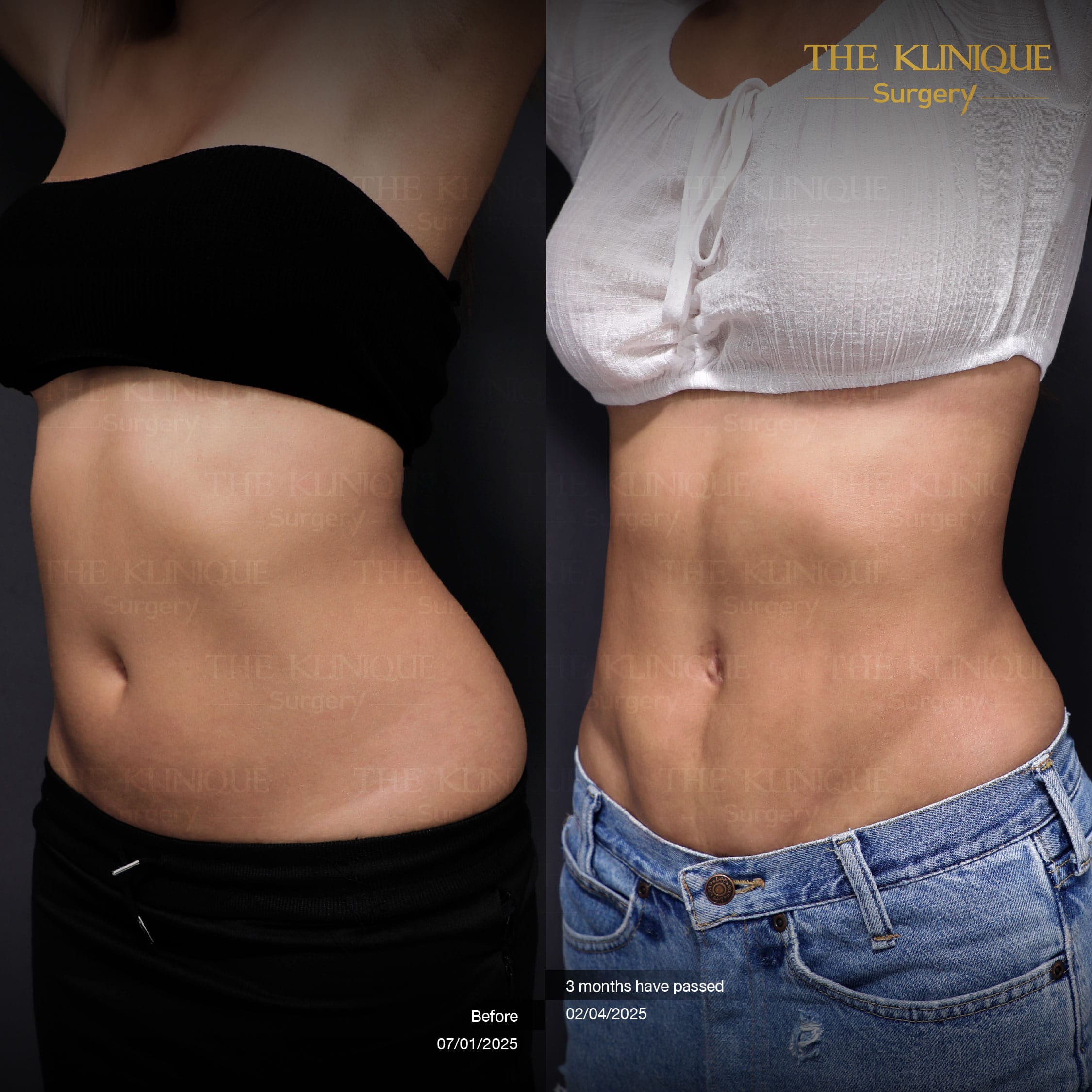 before-after-lipo