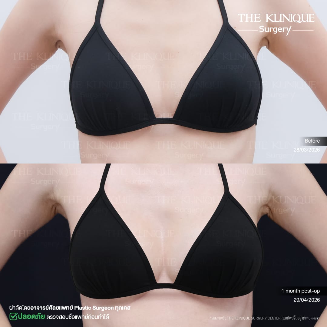 Before-After เสริมหน้าอก