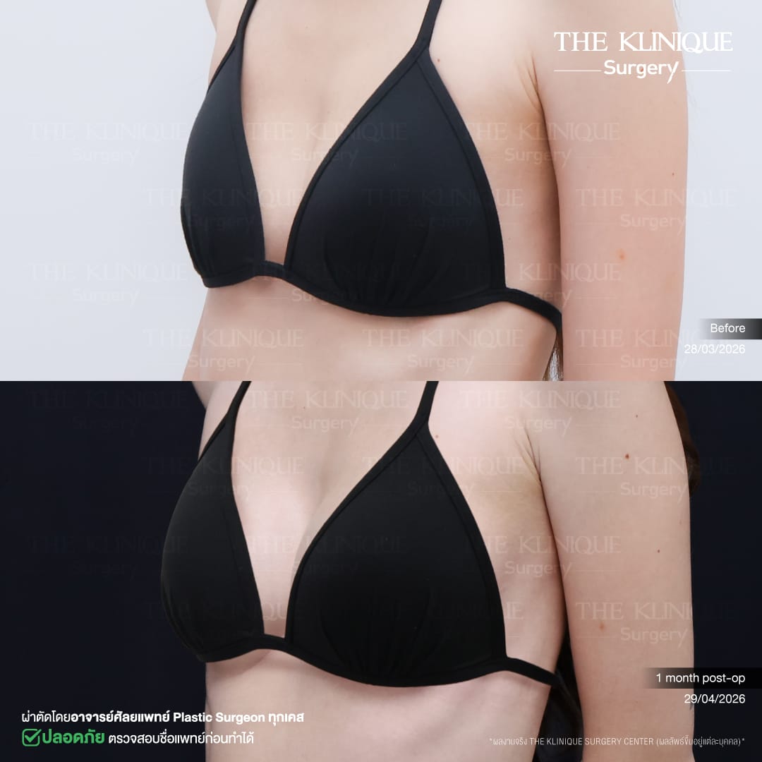 Before-After เสริมหน้าอก
