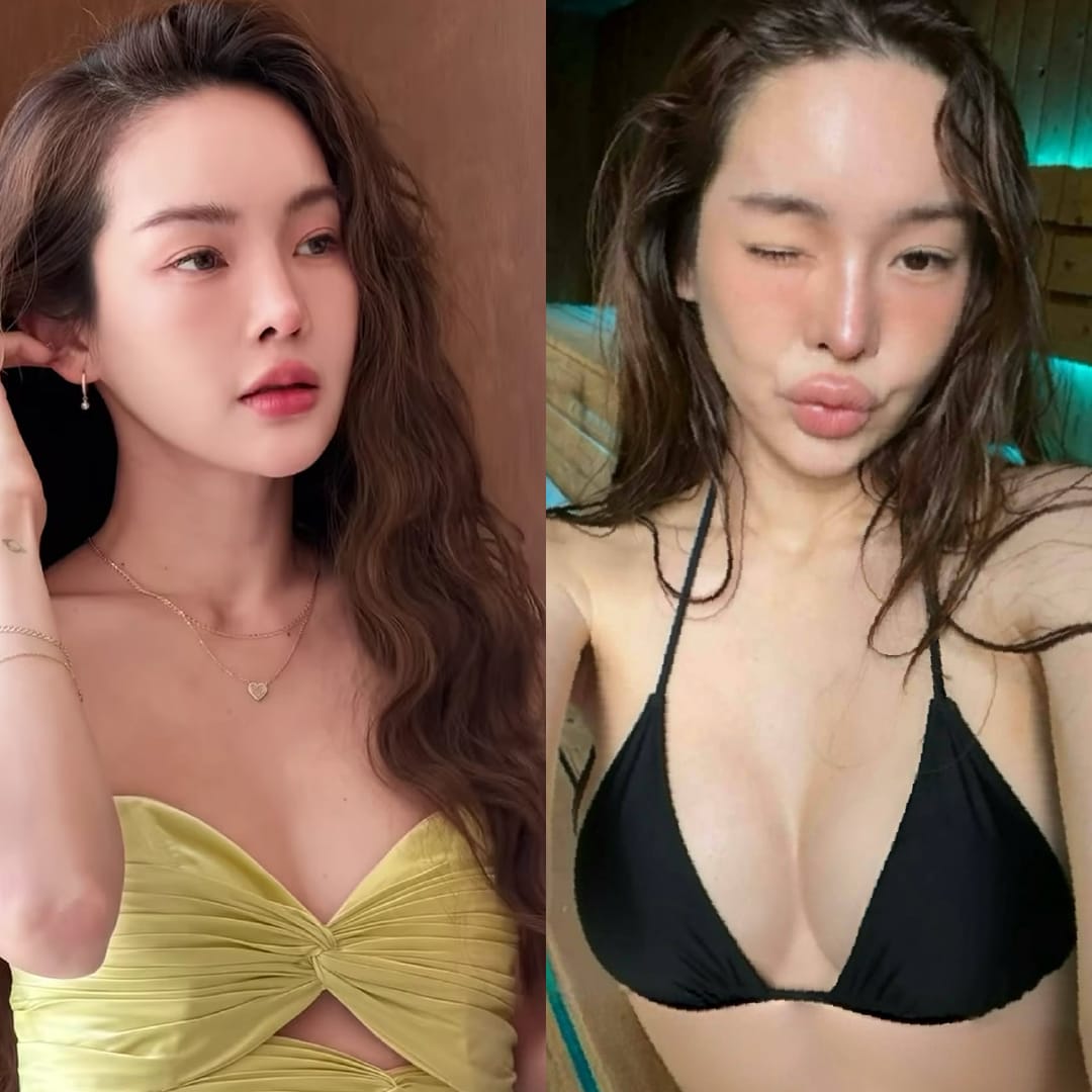 รีวิวเสริมหน้าอกครั้งแรก