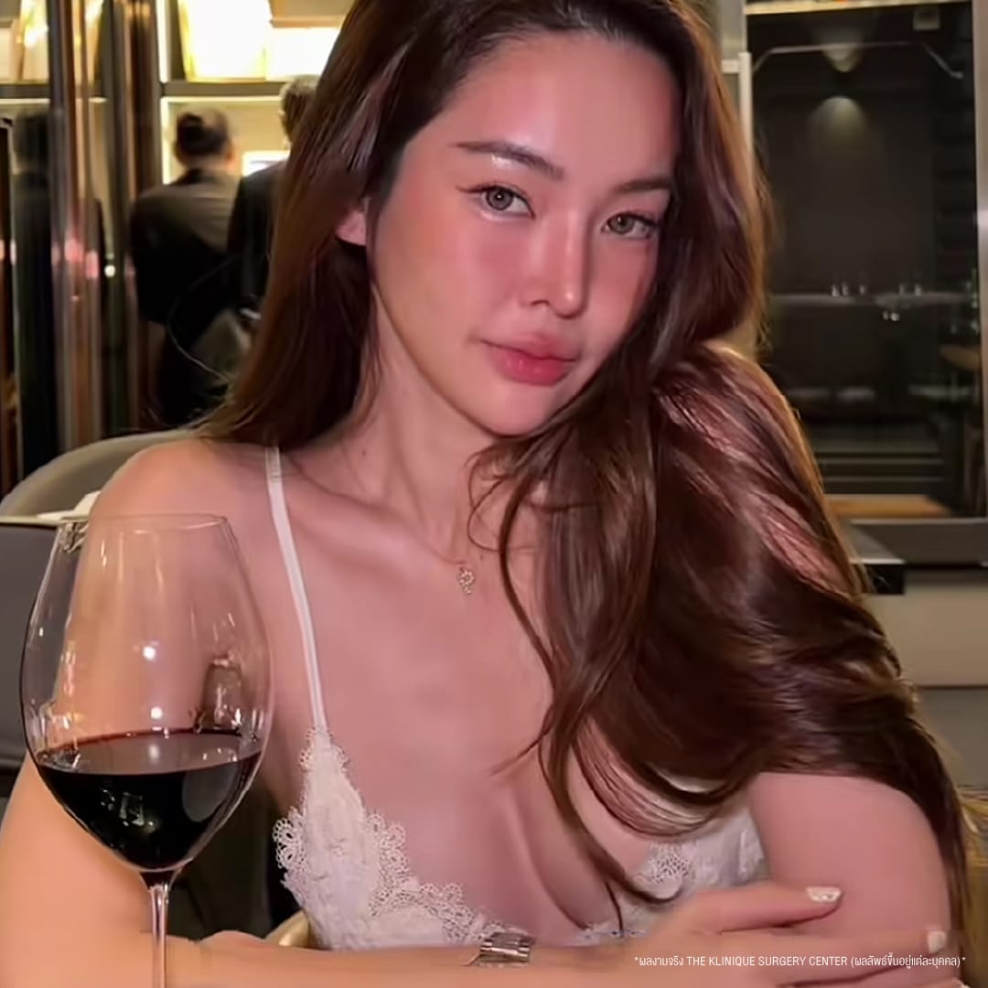 รีวิวเสริมหน้าอกครั้งแรก