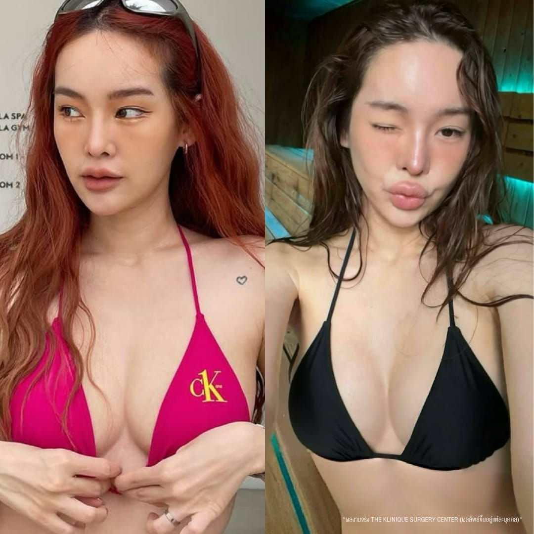 Before-After เสริมหน้าอก