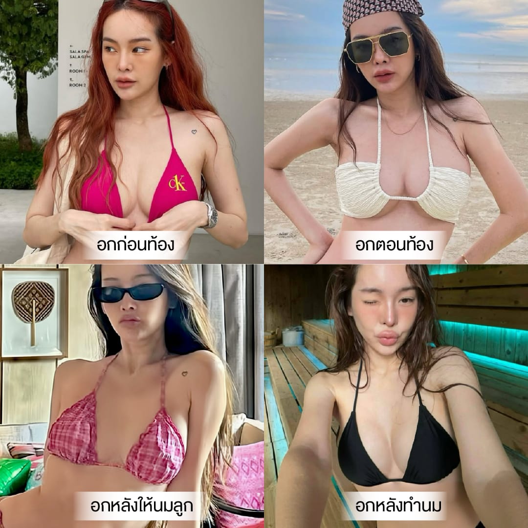 Before-After เสริมหน้าอก
