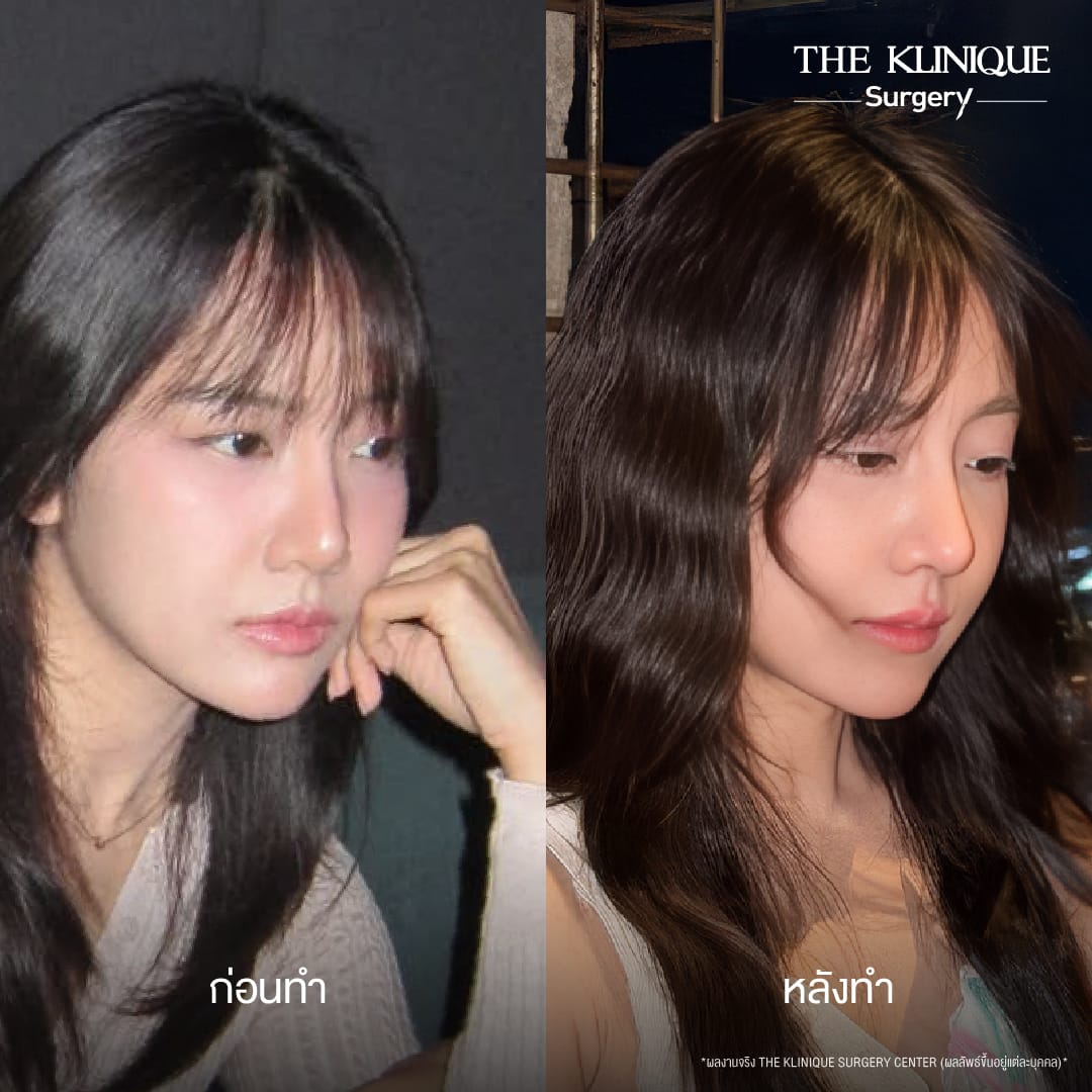 before after semi open