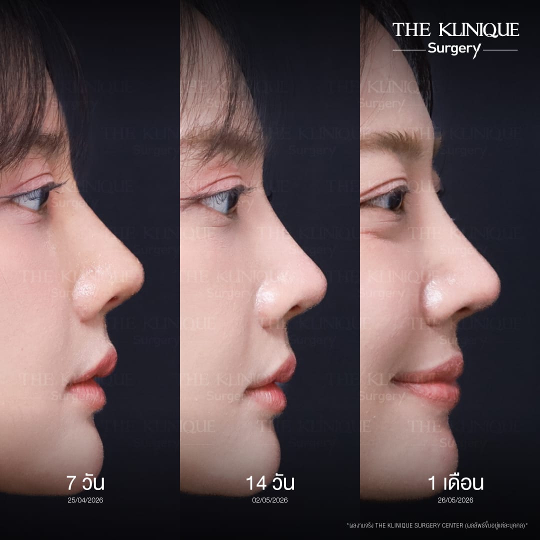 Semi open rhinoplasty technique