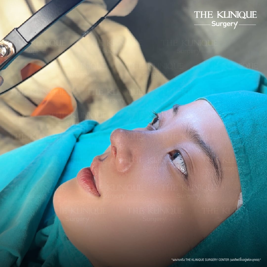 Semi open rhinoplasty technique