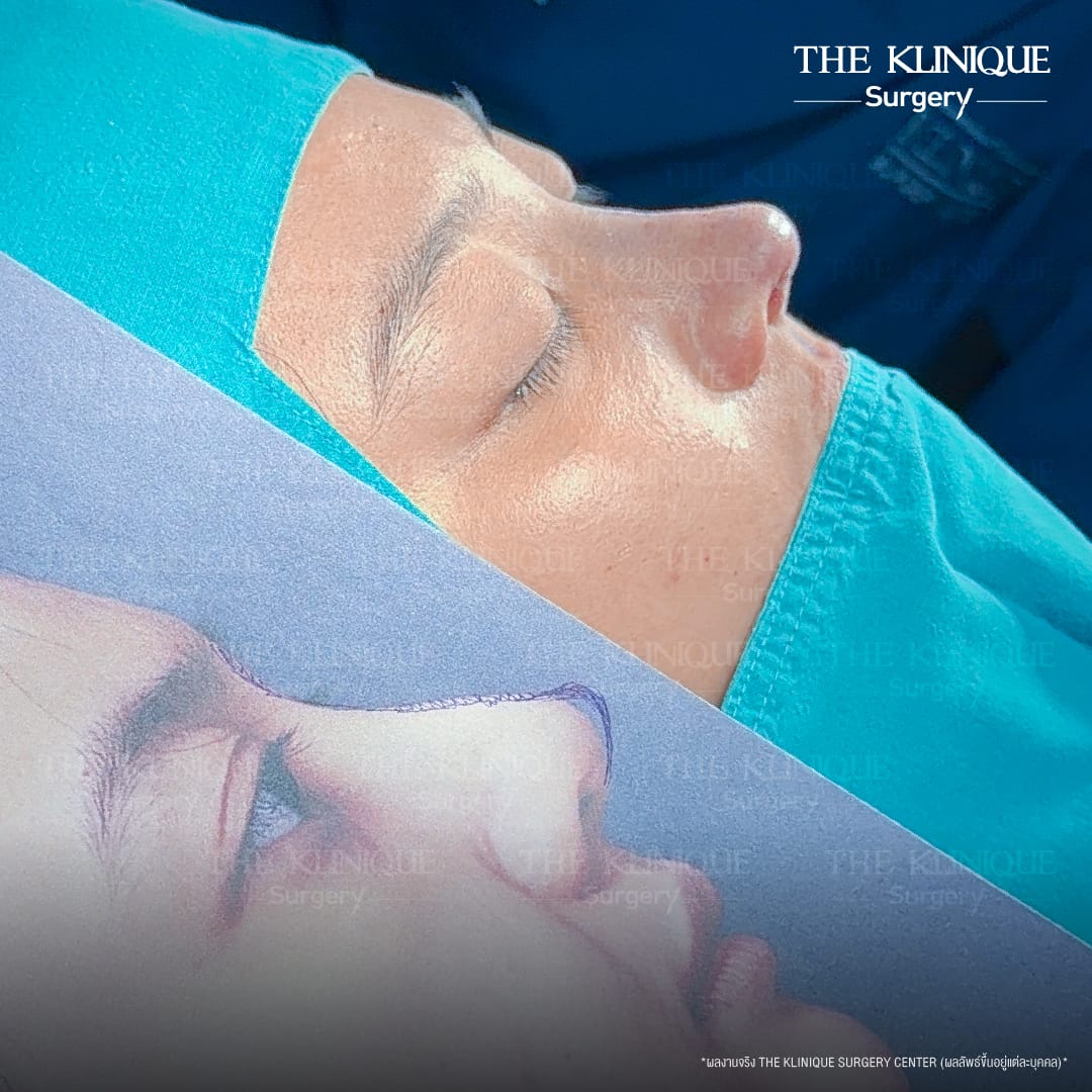 Semi open rhinoplasty technique