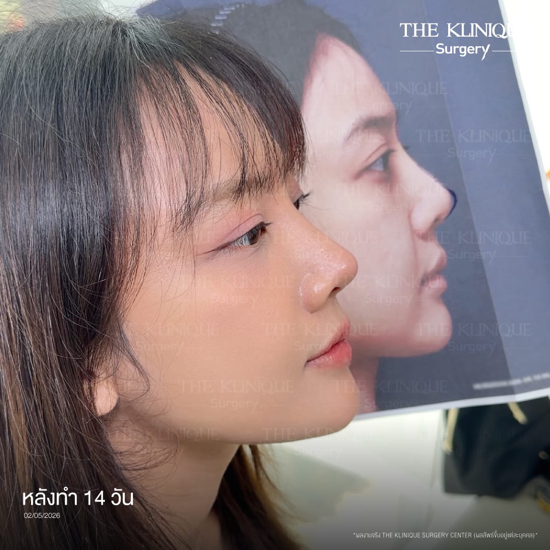 after Semi open rhinoplasty technique