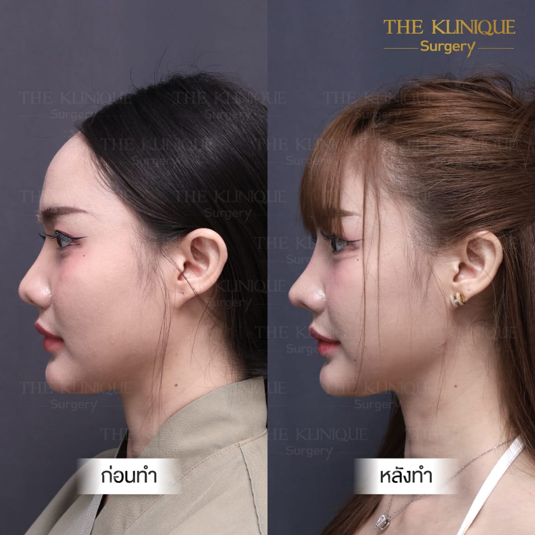 Before After Semi Open